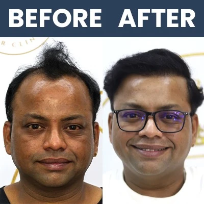 Actor - Hair Transplant