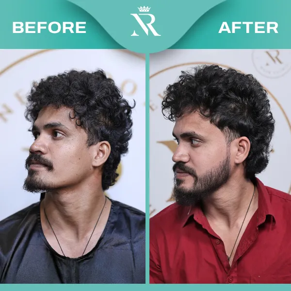 Beard Hair Transplant