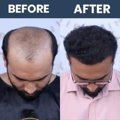 FUE Hair Transplant