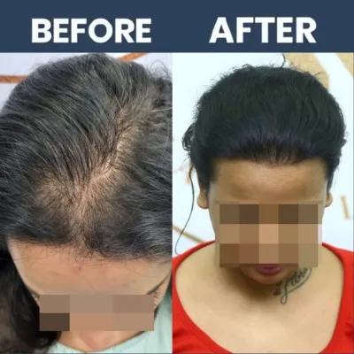 Female Hair Transplant