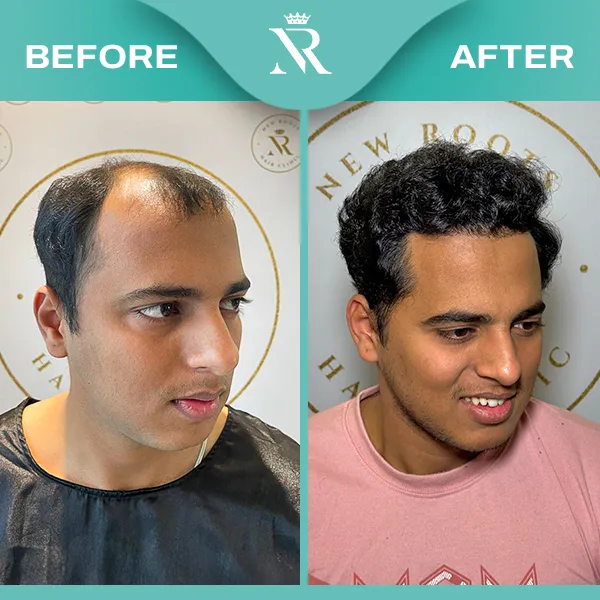 Sapphire Fue Hair Transplant