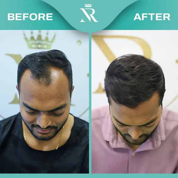 Sapphir Fue Hair Transplant