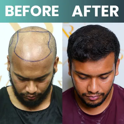 Hair line Design