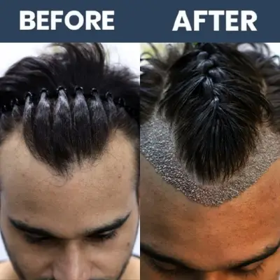 No Shave Hair Transplant